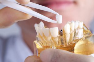 תהליך השתלות שיניים